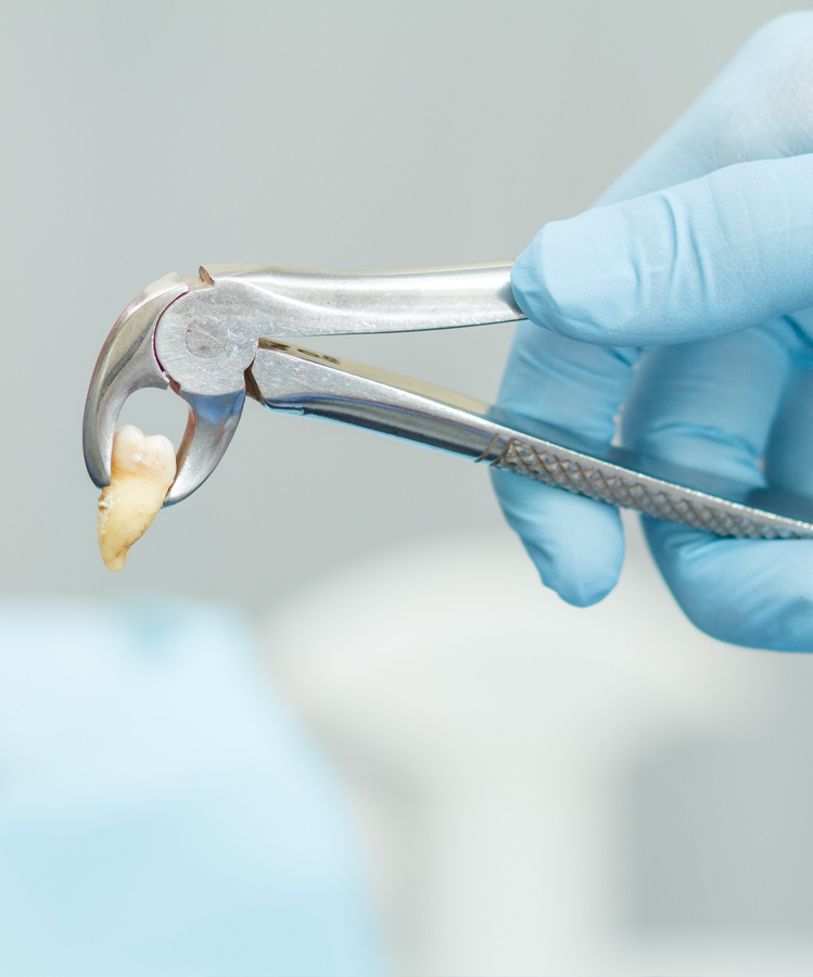 Tooth extraction at SAMDENT webpage