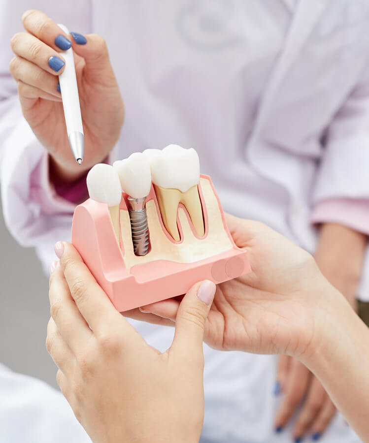 Tooth implant at SAMDENT Webpage